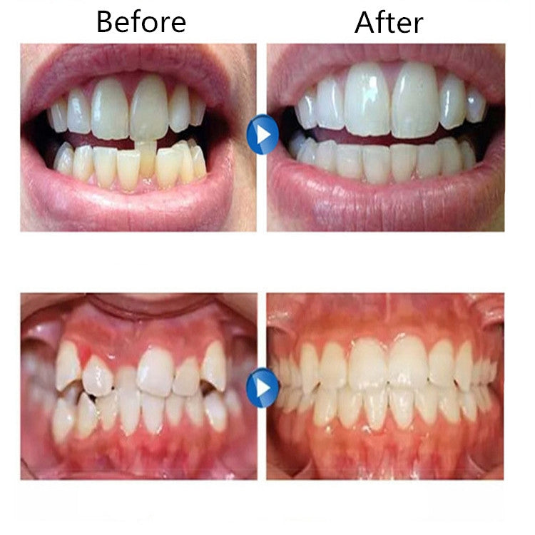 Orthodontic Appliance Silicone Simulation Braces Anti-molar Braces for Night(The first stage) - Dental Tools by PMC TechLife | Online Shopping South Africa | PMC TechLife